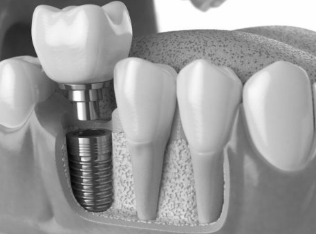 Implantologia dentale